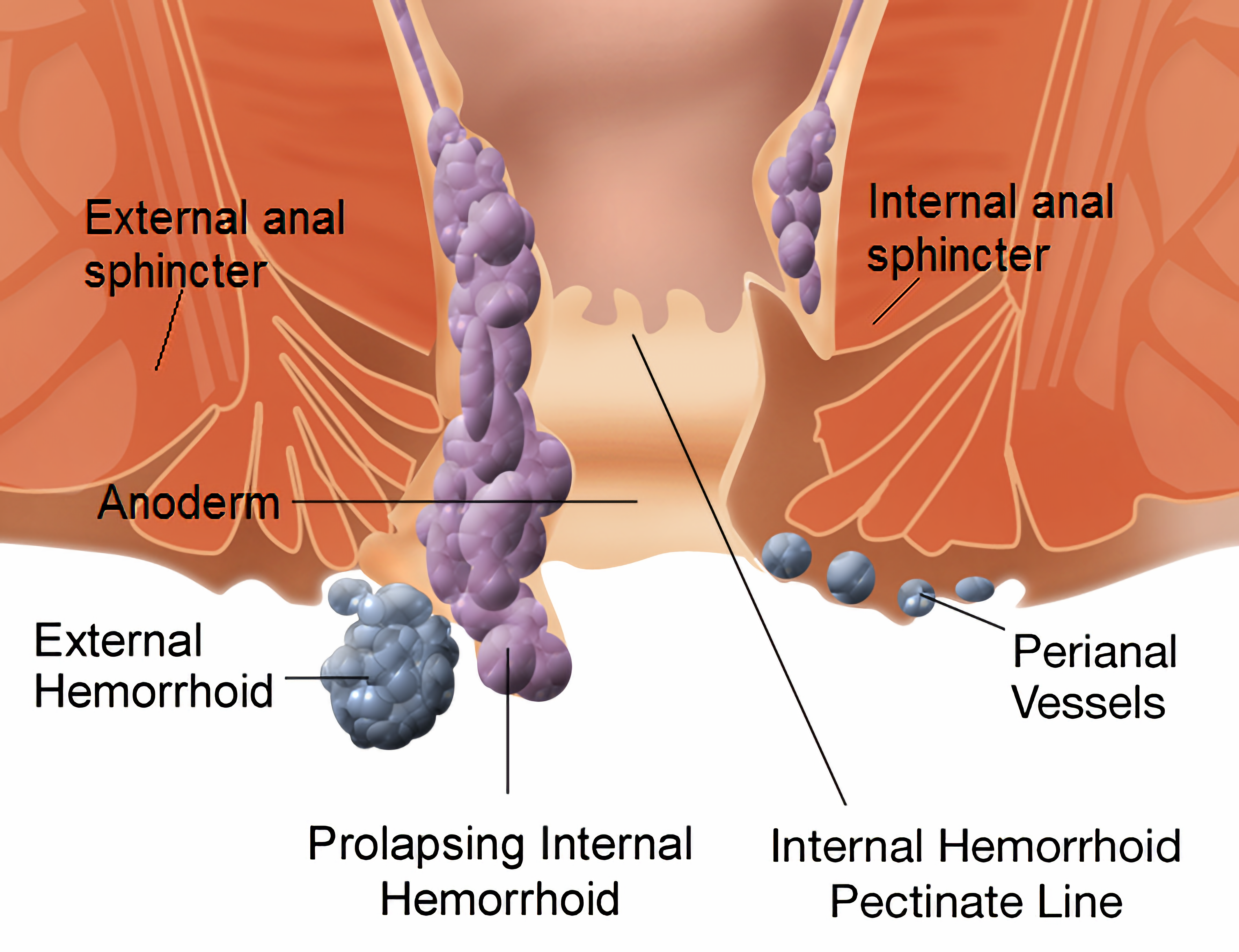 Hemorrhoidectomy In India