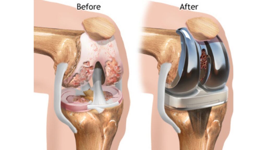 Complete knee replacement