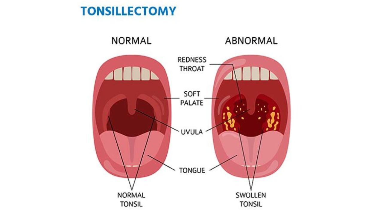 Tonsillectomy Treatment