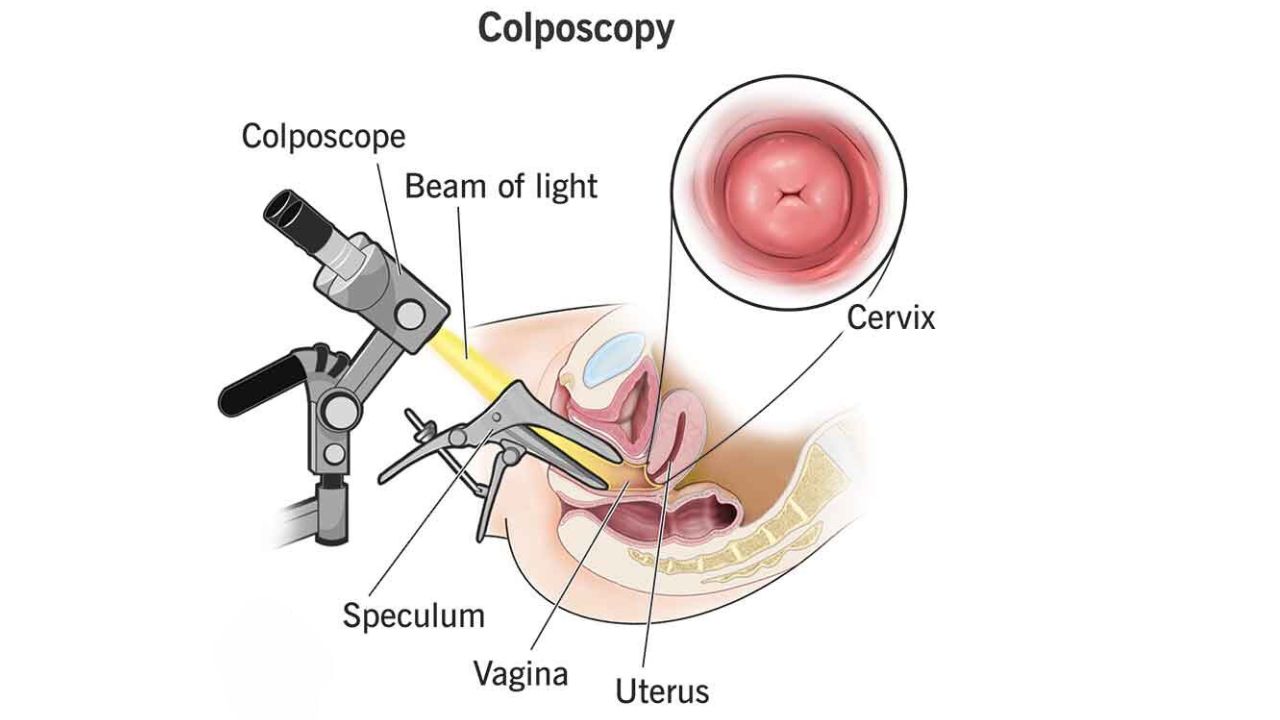 Colposcopy surgery