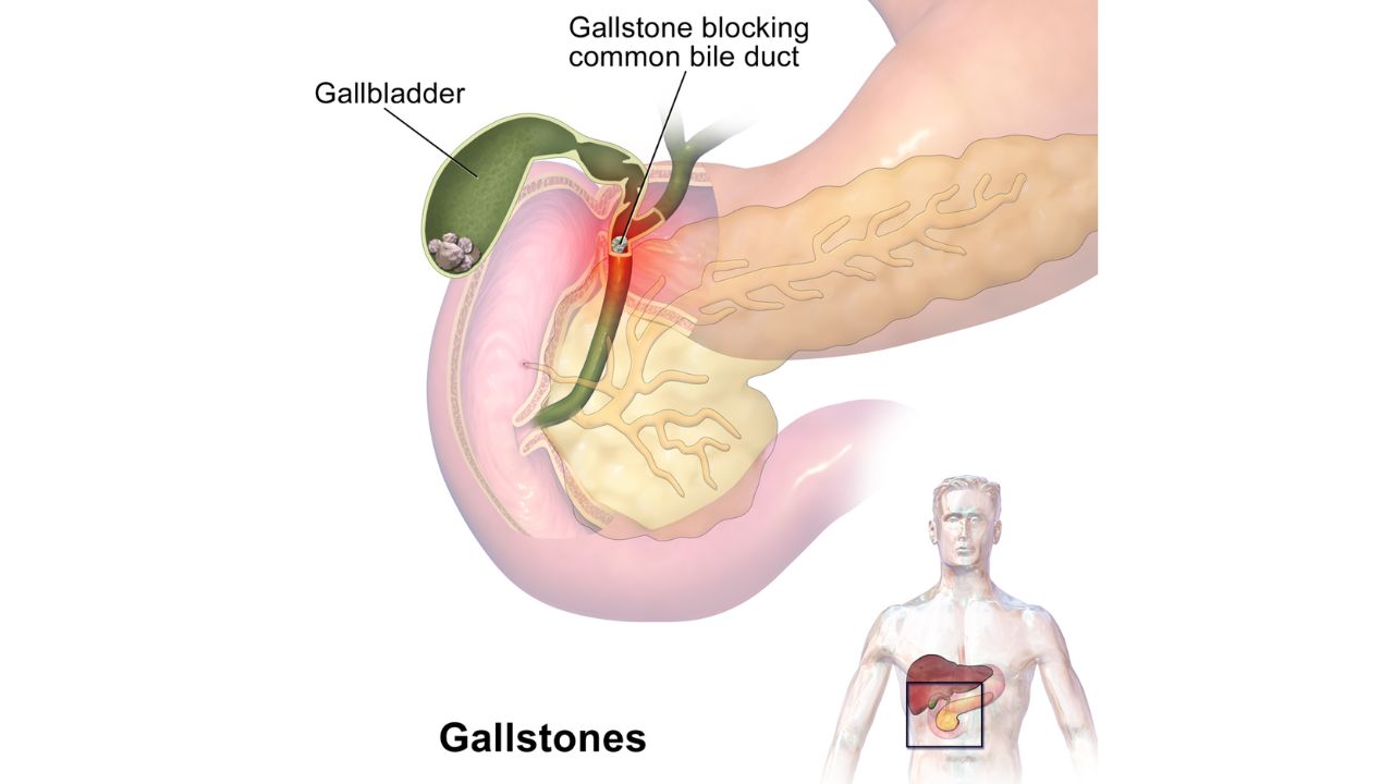 GALLSTONE REMOVAL SURGERY