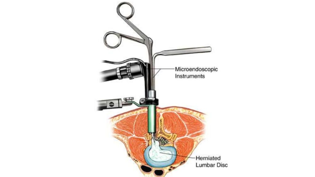 Minimally Invasive Spine Surgery