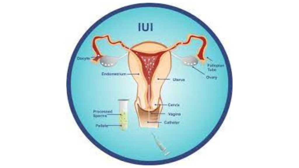 IUI Treatment In India