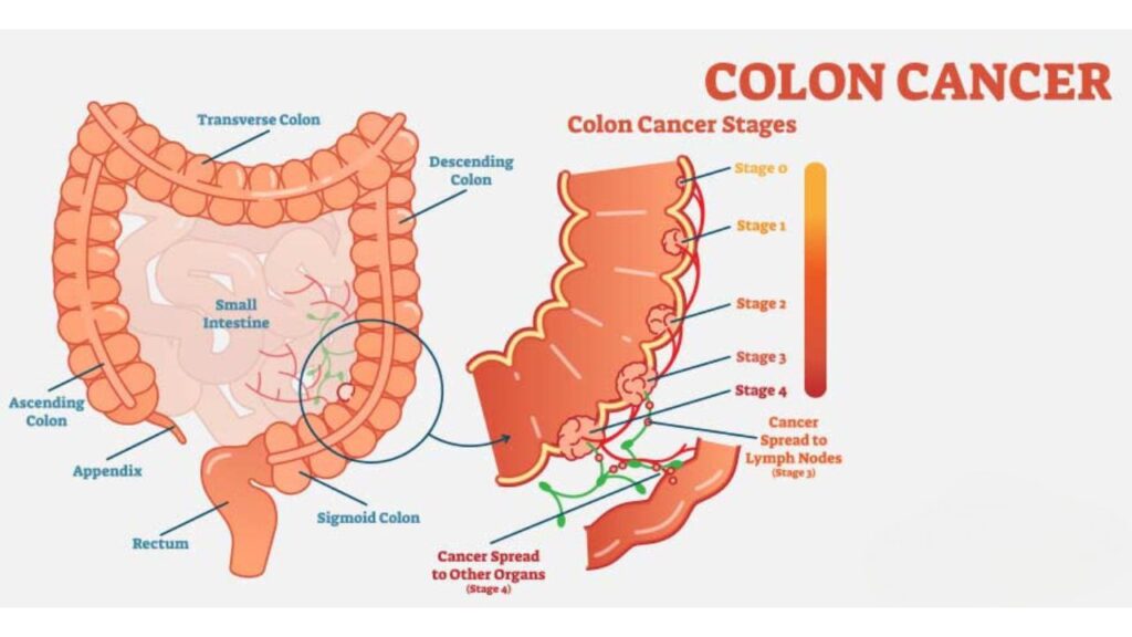 Colon Cancer Treatment