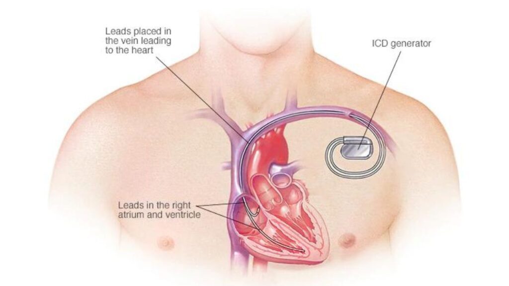 Automatic Implantable Cardioverter Defibrillator