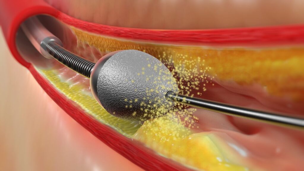 Rotational Angioplasty In India