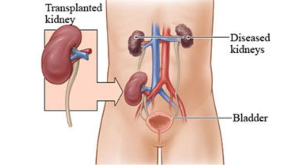 Kidney Transplant In India