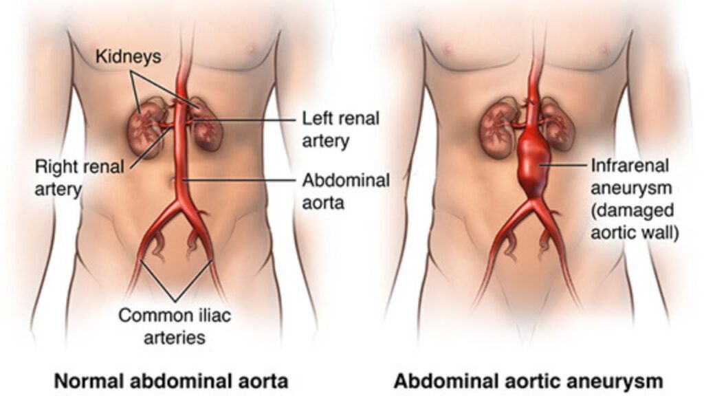 Abdominal Aortic Aneurysm Treatment