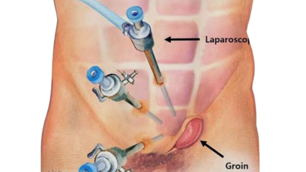 Bilateral Inguinal Hernia Laparoscopic