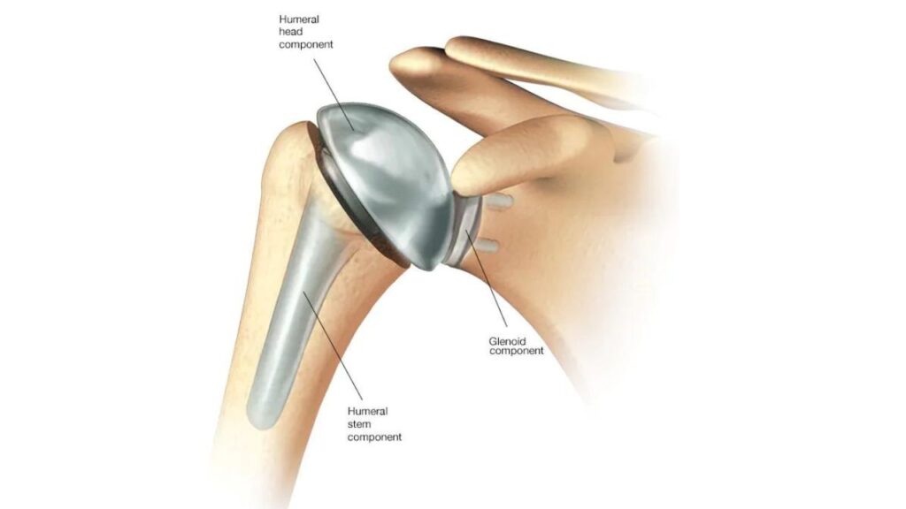 Total Shoulder Replacement