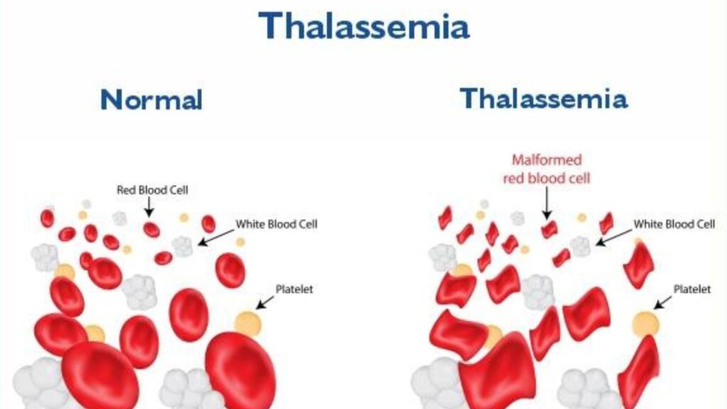 Thalassemia Treatment In India