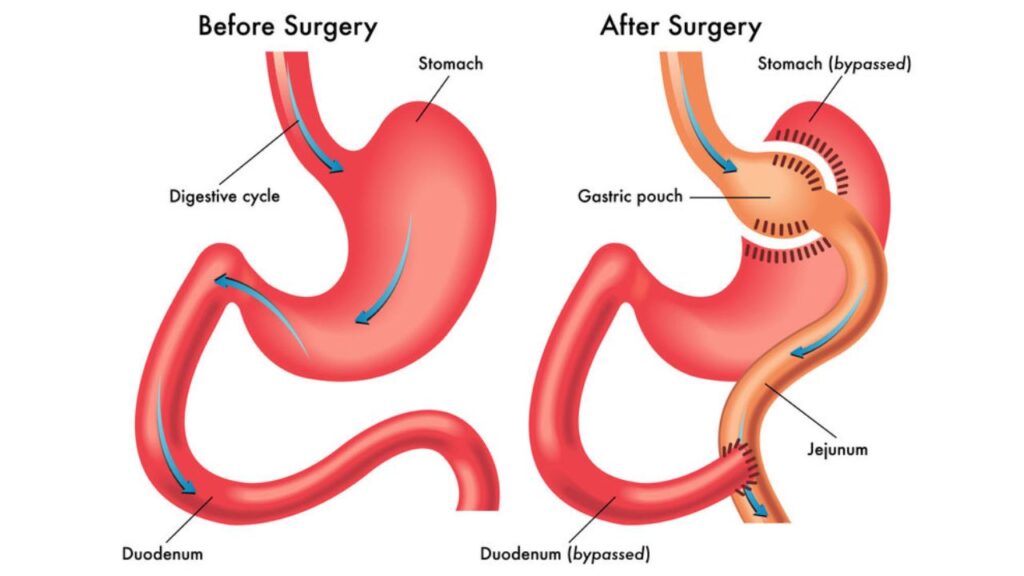 Gastric Surgery in India