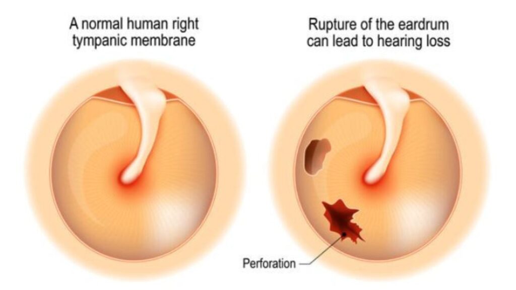 Chronic Otitis Media Treatments