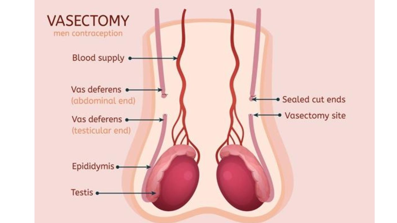 Vasectomy In India