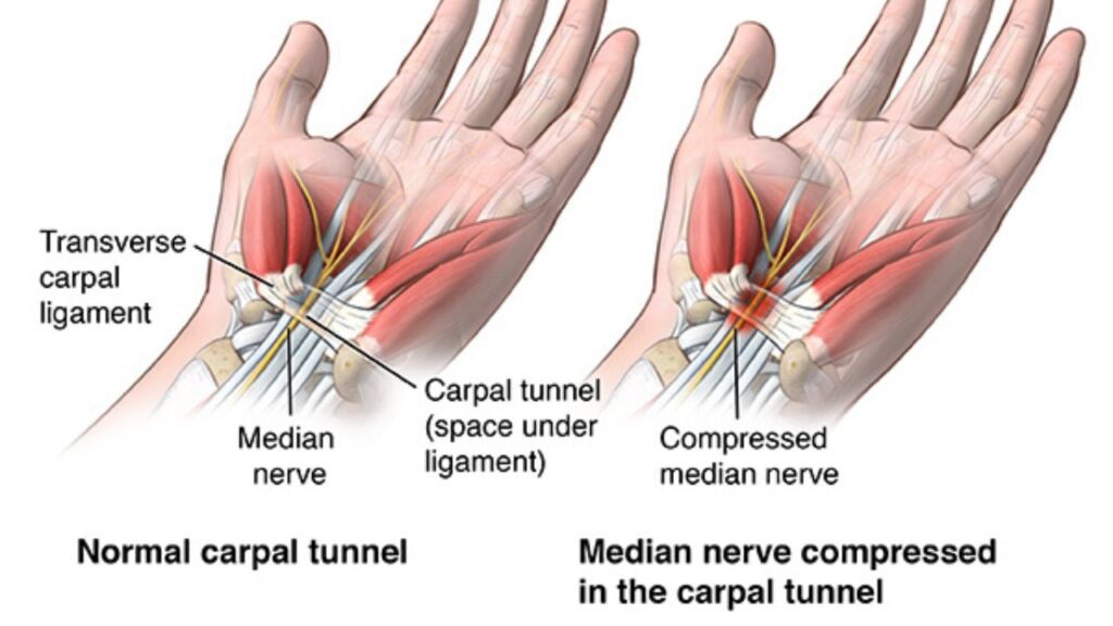 Carpal Tunnel Release