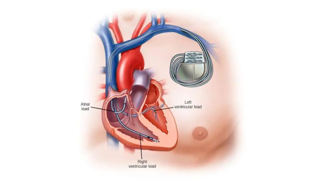 Pacemaker