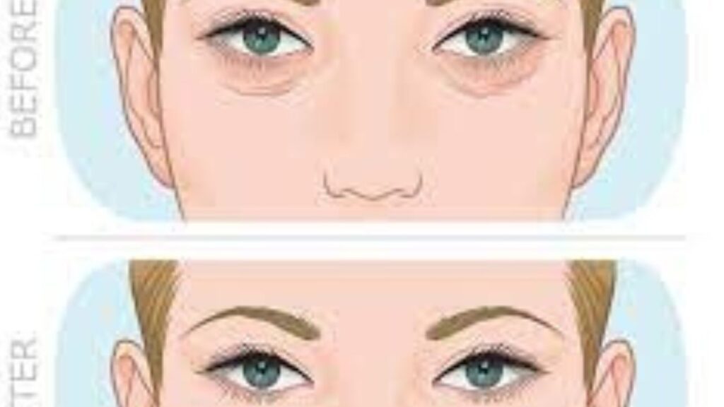 Upper Eyelid Surgery