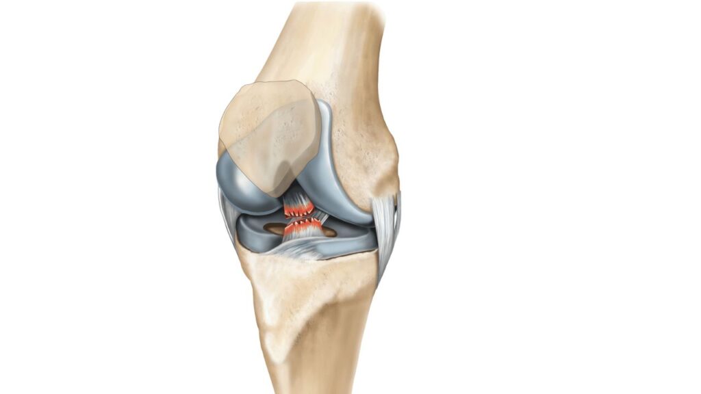 Anterior Cruciate Ligament Repair