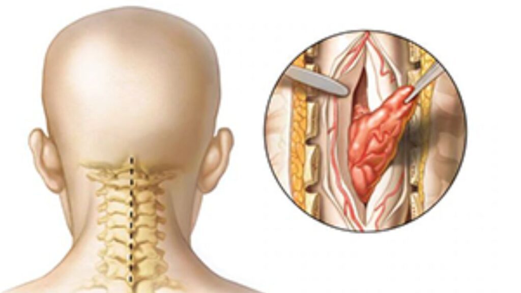 Spine Tumor Surgery in India