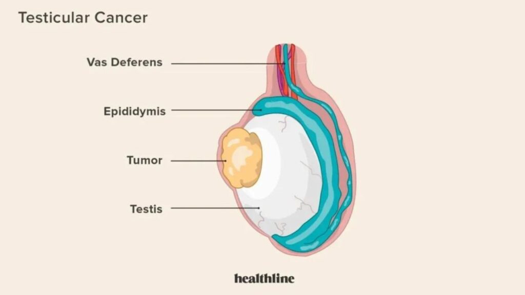 Testicular Cancer Treatment in India