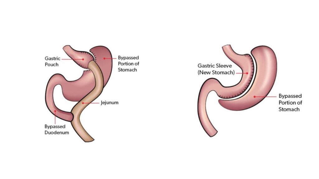 Bariatric Surgery In India