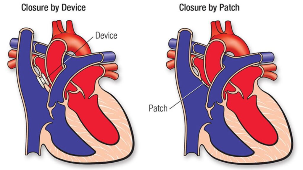 Asd Atrial Septal