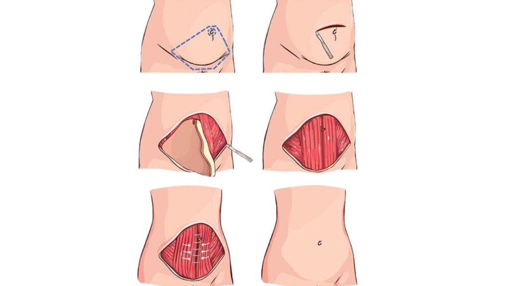 Tummy Tuck