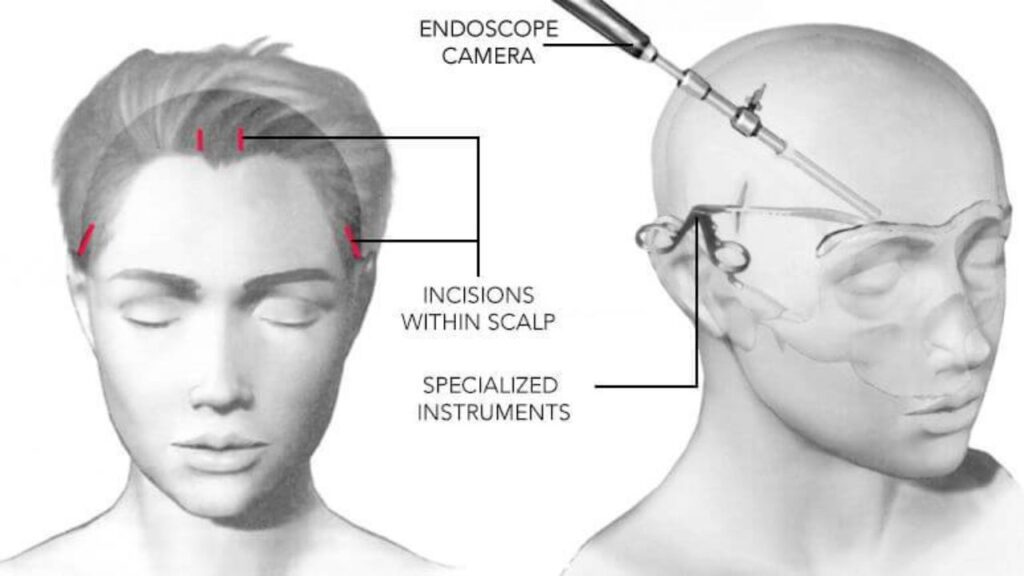 Forehead / Brow Lift Surgery