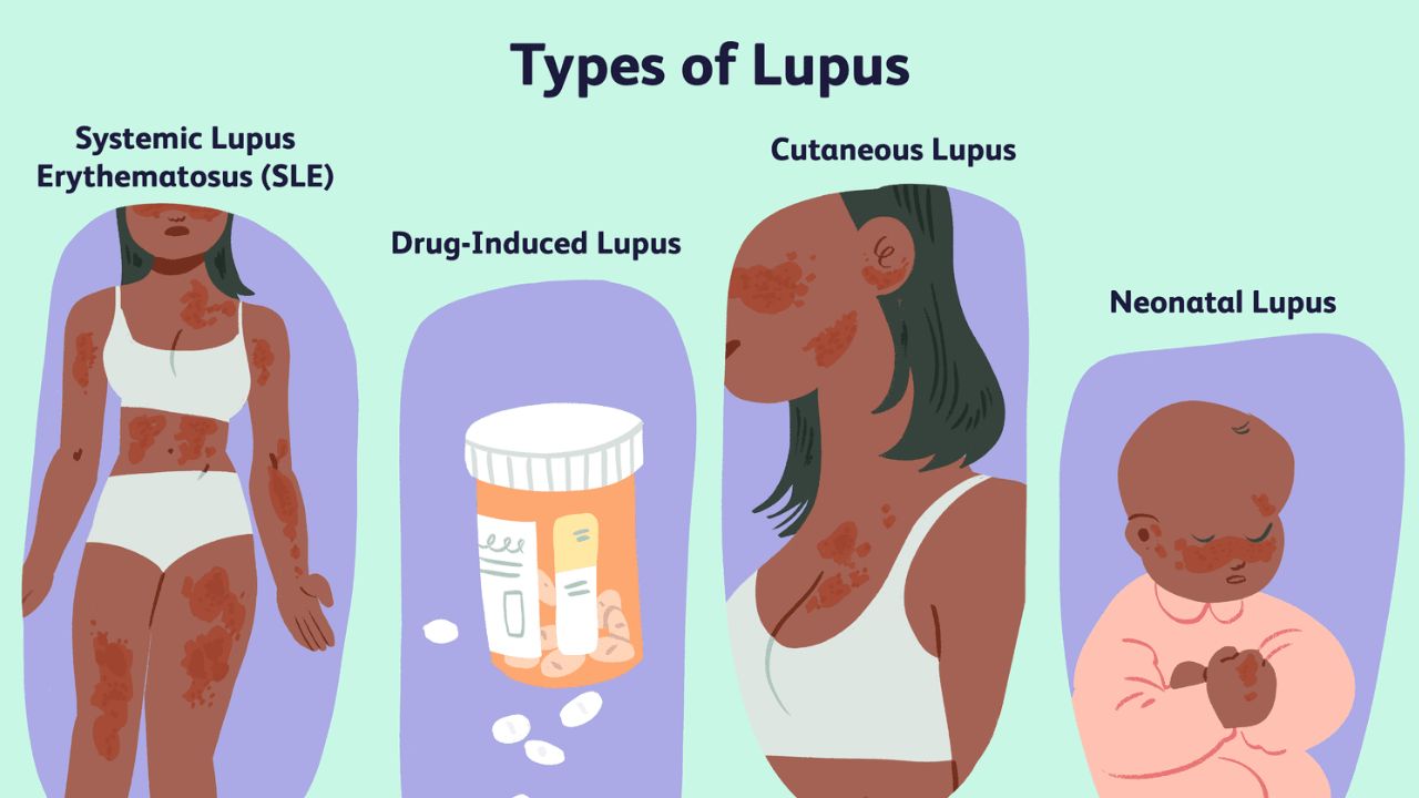 Lupus Treatment In India