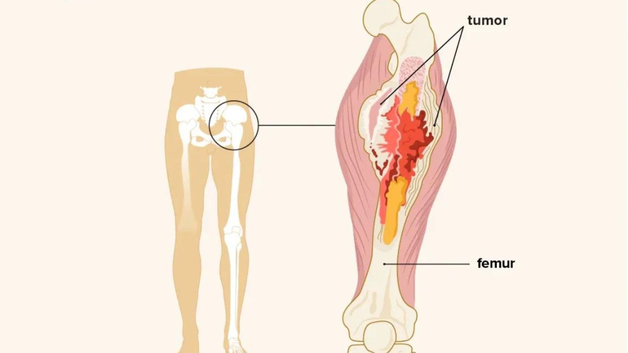 Musculoskeletal Cancer
