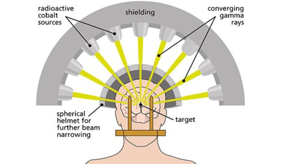 Gamma Knife In India