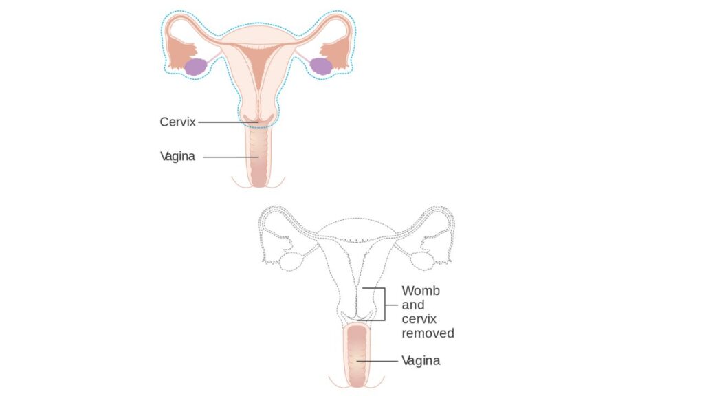 Hysterectomy In India