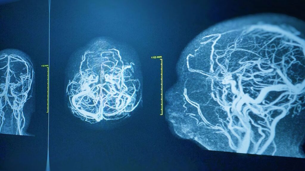 Cerebral Angiogram In India