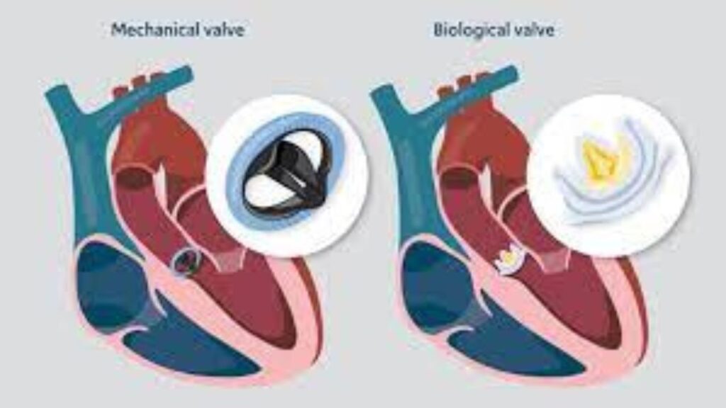 Coronary Valve Replacement