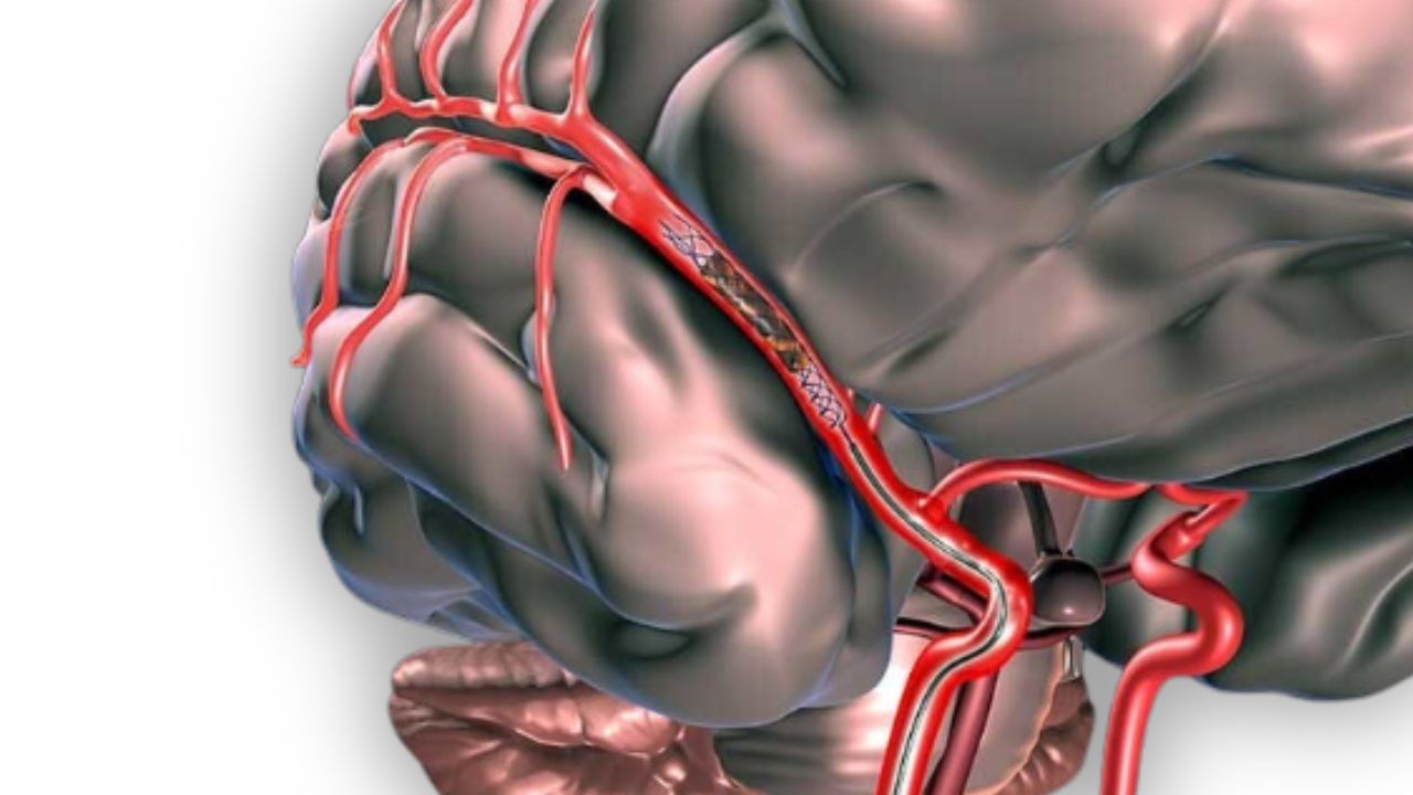 Blood Clot Brain Surgery In India