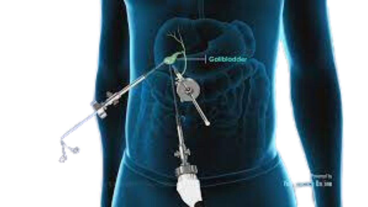 Cholecystectomy In India