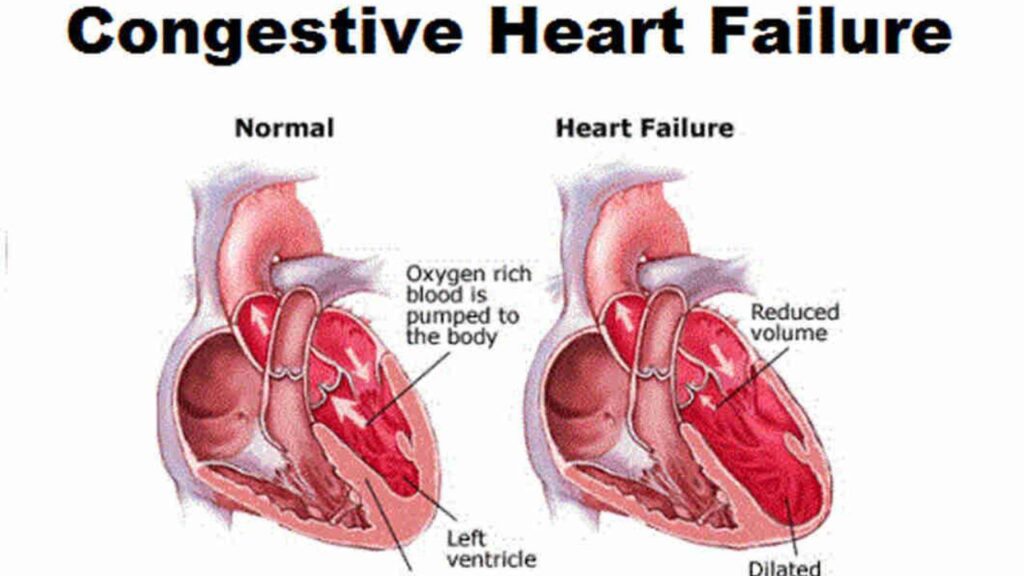 Congestive Heart Failure