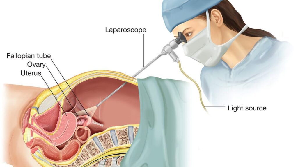 Laparoscopic Gynecological Surgery