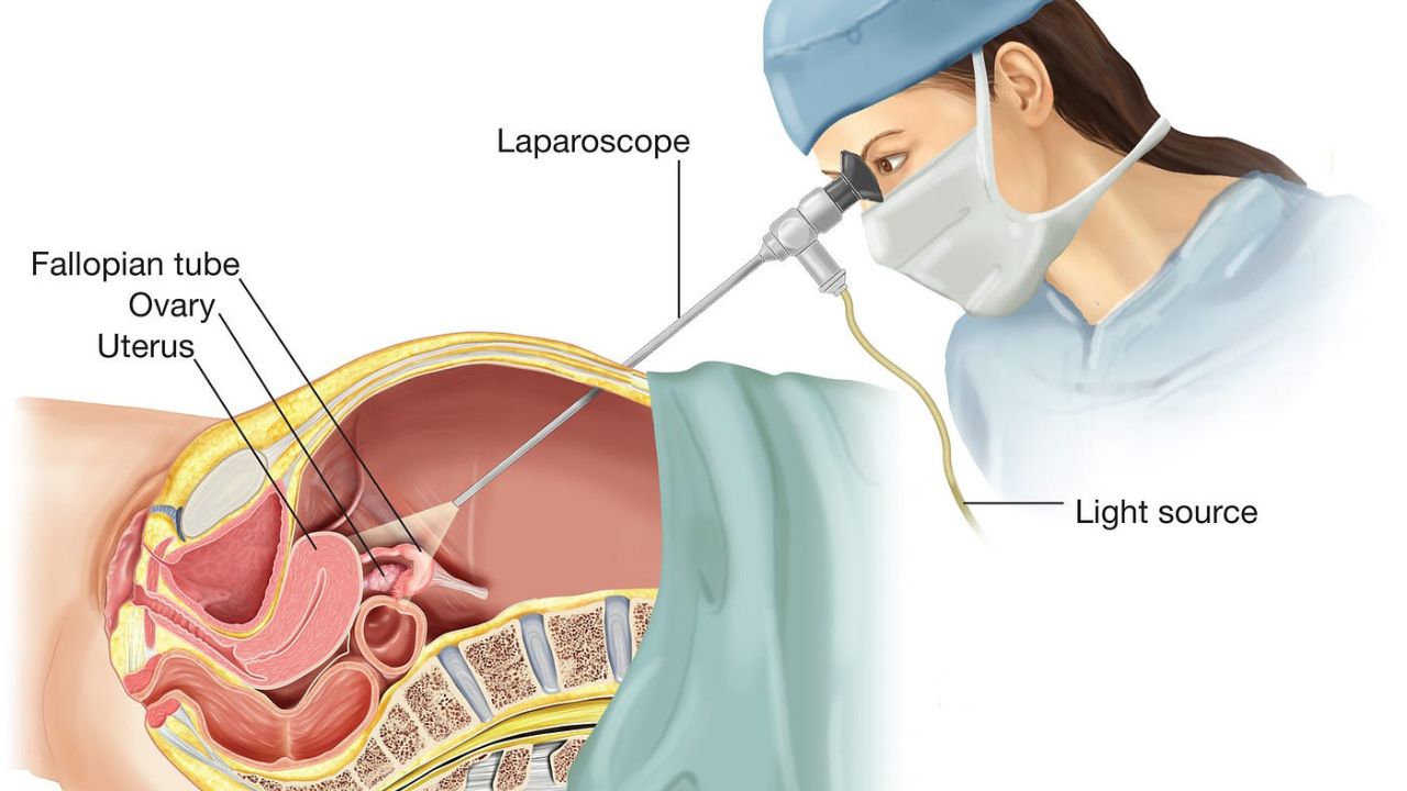 Laparoscopic Gynecological Surgery