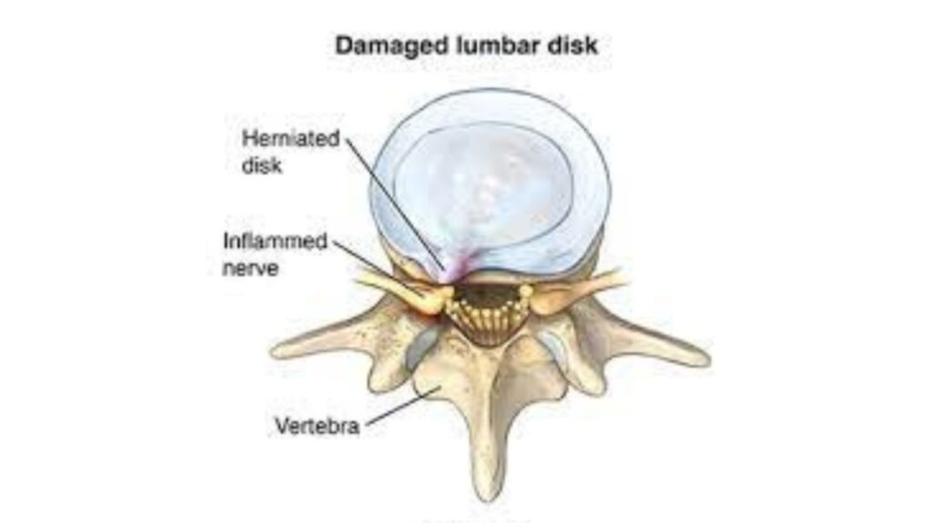 Lumbar Laminectomy In India