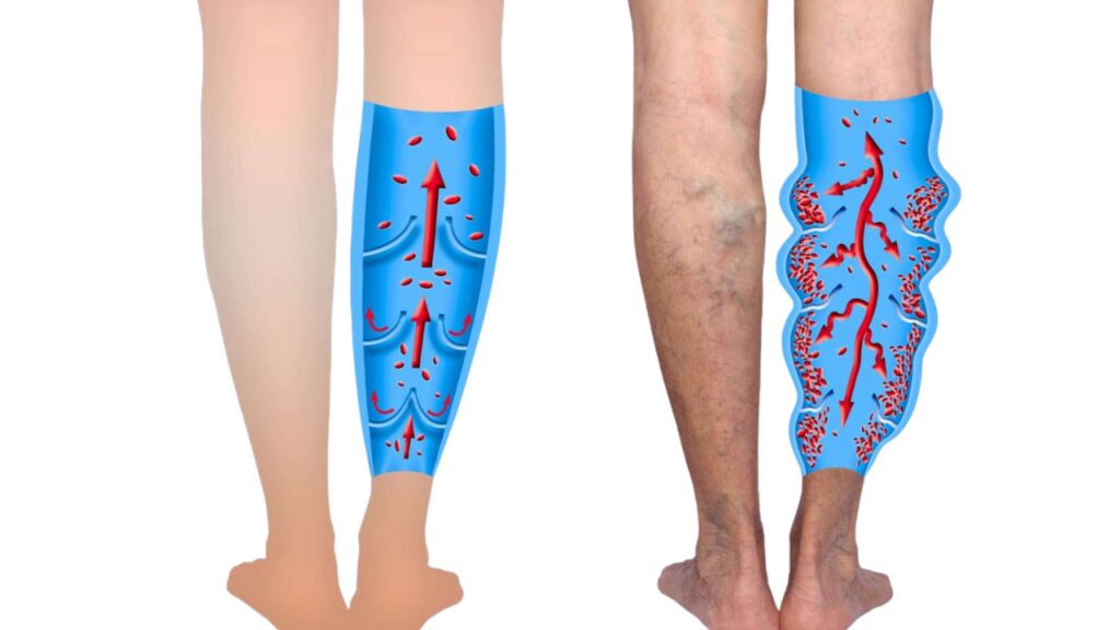 Varicose Veins Treatment