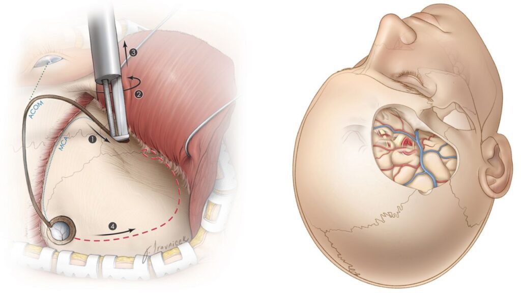 Craniotomy In India