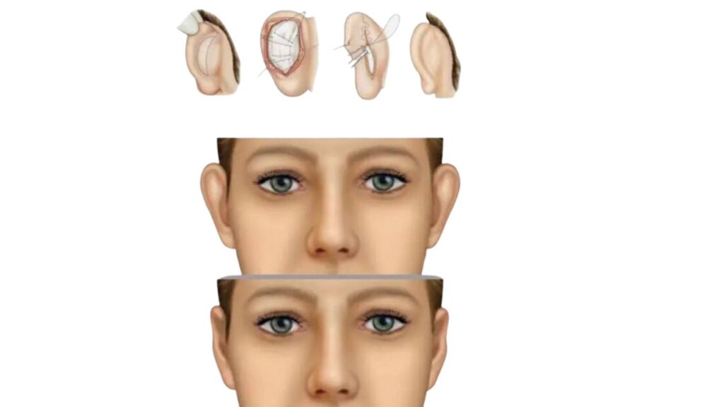 Otoplasty in India