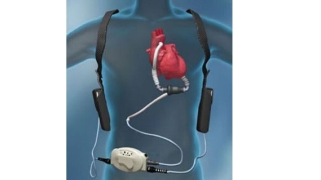 Left Ventricular Assist Device Transplant in India