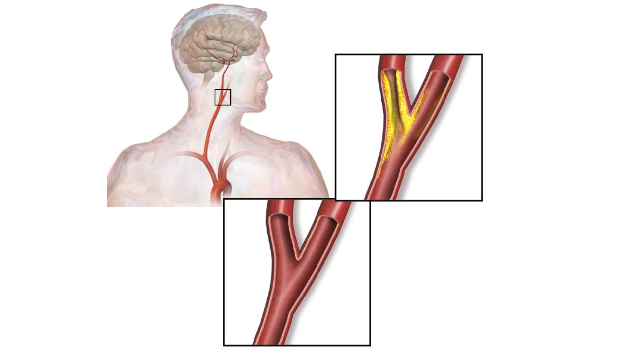 Carotid Artery Stenosis Treatment