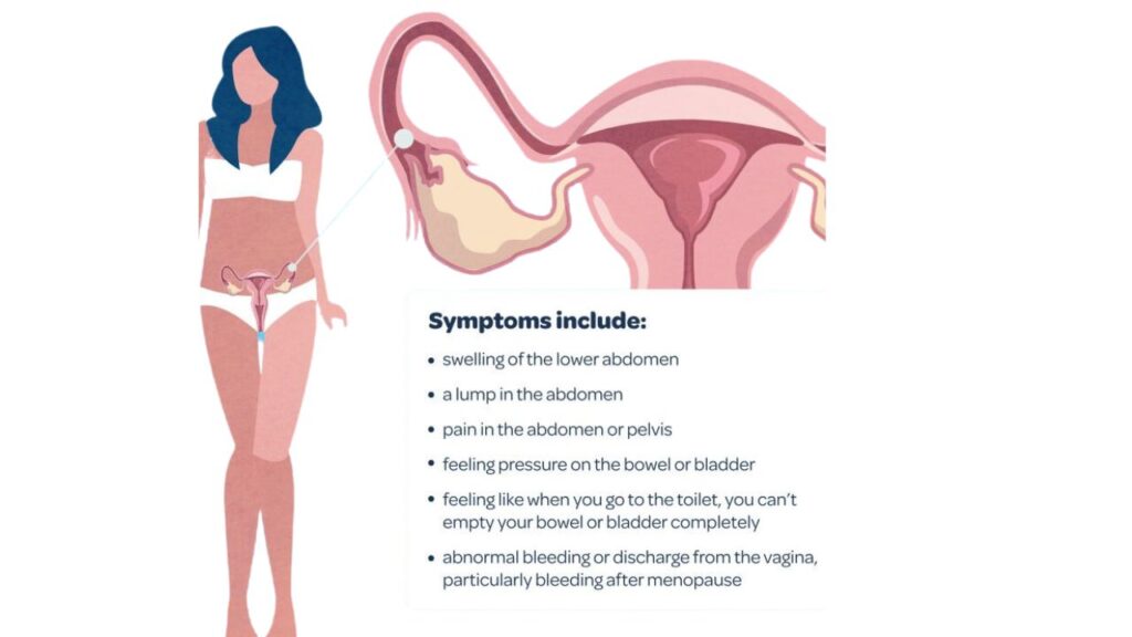 Fallopian Tube Cancer