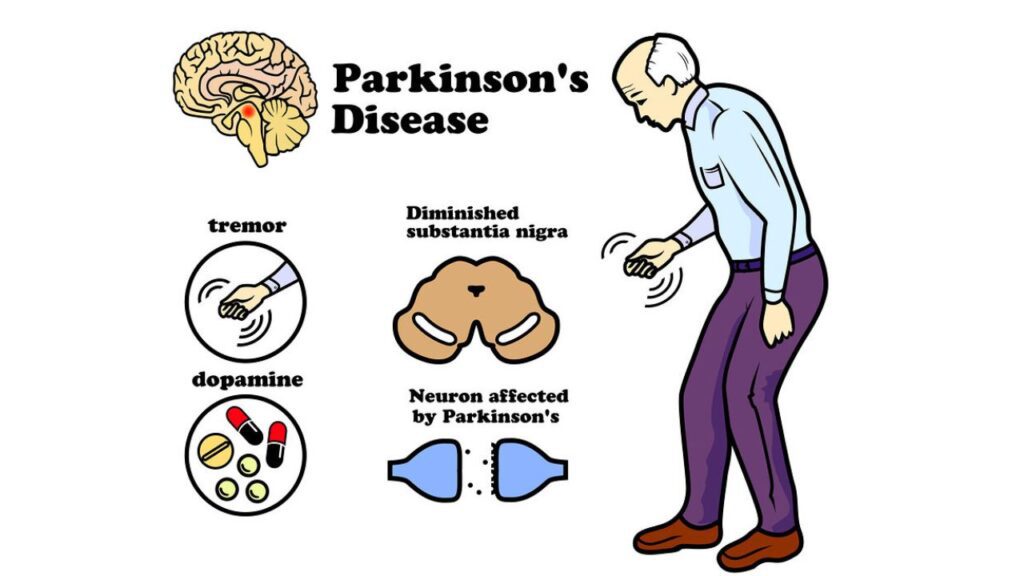 Parkinson’s Disease