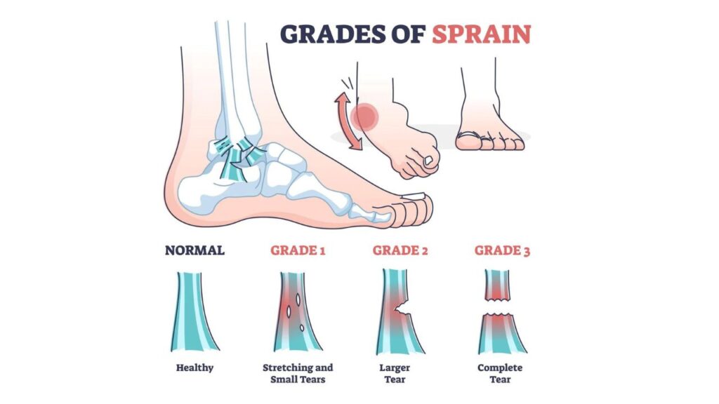 Ankle Sprain Treatment