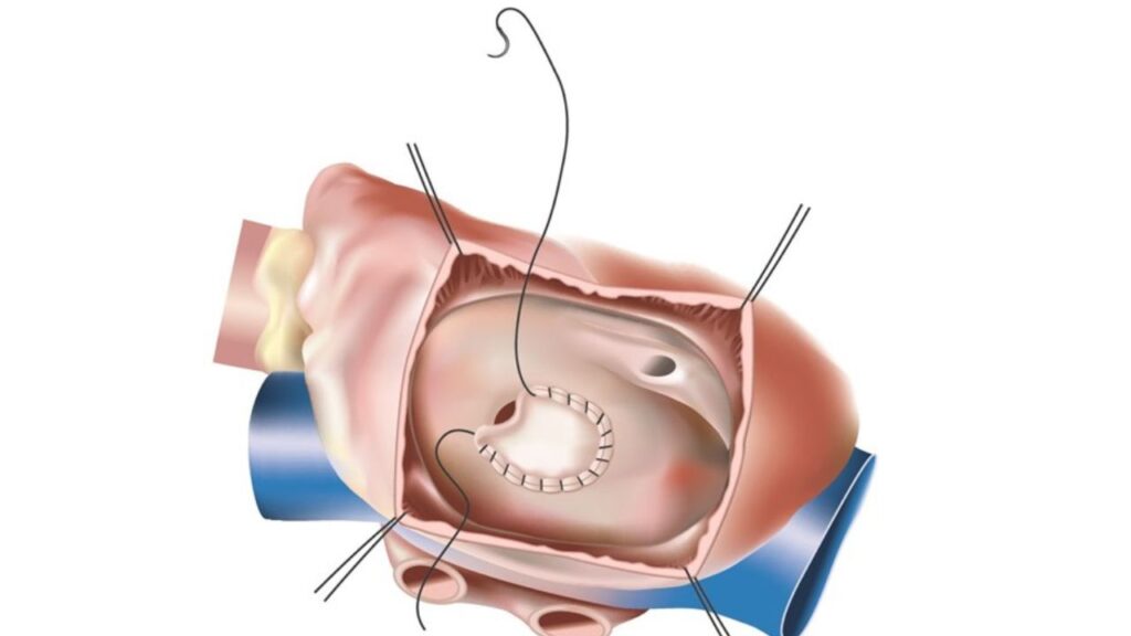 ASD Closure Surgery