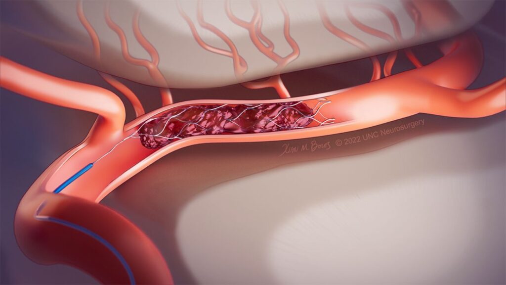 Brain Aneurysm Repair